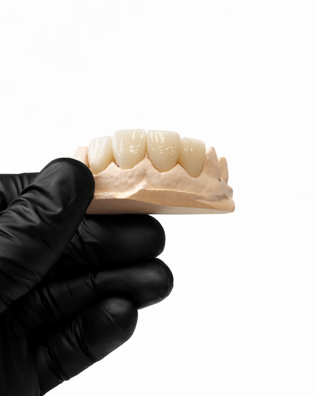 Zirconia Veneer  -  strength and aesthetics